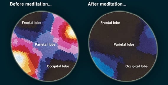 brain before and after meditation 2ndskiesforex