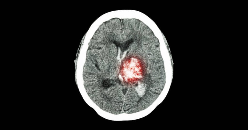 brain image after stroke